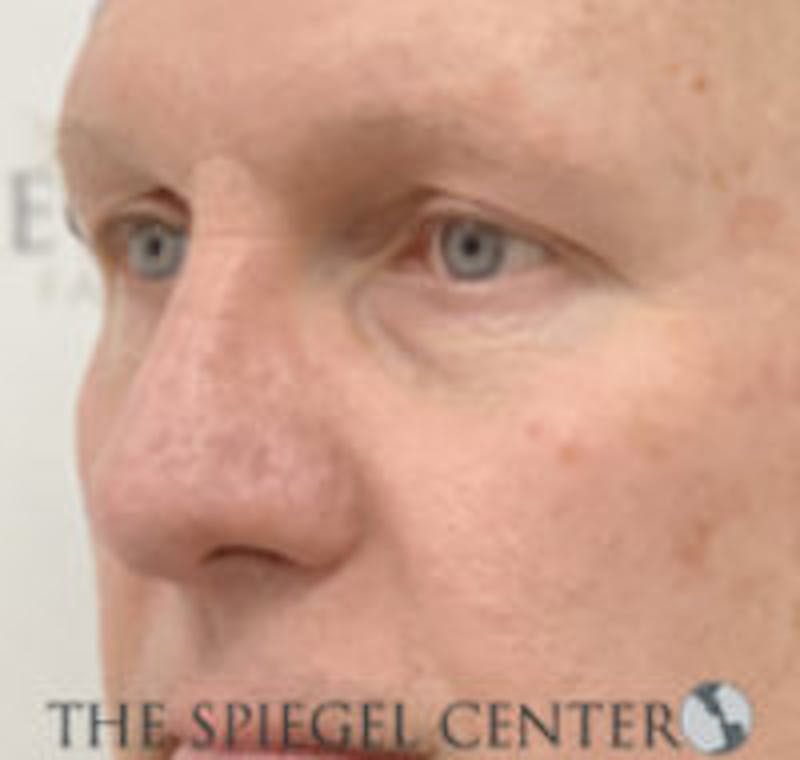 Rhinoplasty Before & After Gallery - Patient 318881 - Image 1