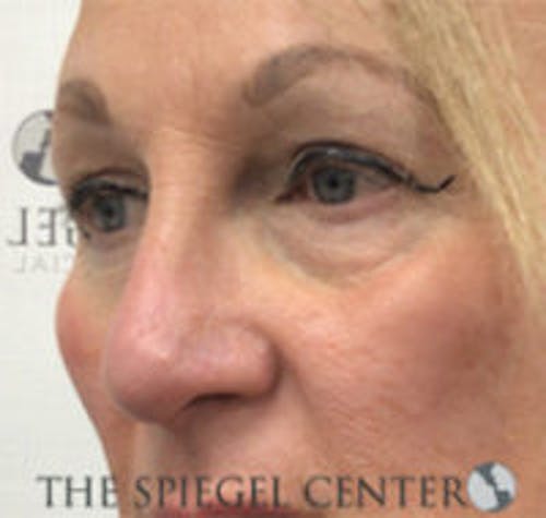 Rhinoplasty Before & After Gallery - Patient 318881 - Image 2