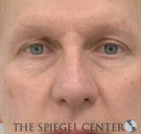 Rhinoplasty Before & After Gallery - Patient 318881 - Image 3