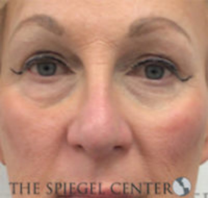 Rhinoplasty Before & After Gallery - Patient 318881 - Image 4