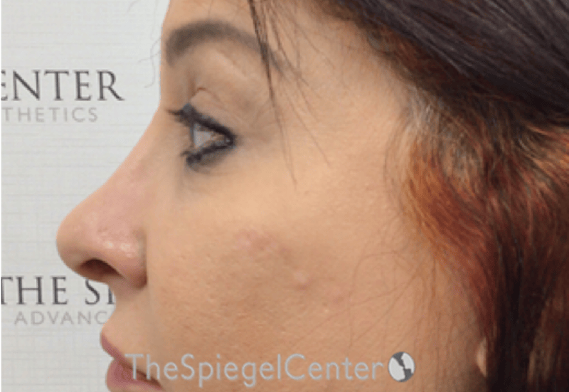 Rhinoplasty Before & After Gallery - Patient 132206 - Image 2