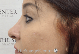 Rhinoplasty Before & After Gallery - Patient 132206 - Image 2