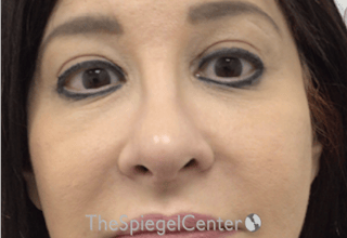 Rhinoplasty Before & After Gallery - Patient 132206 - Image 4