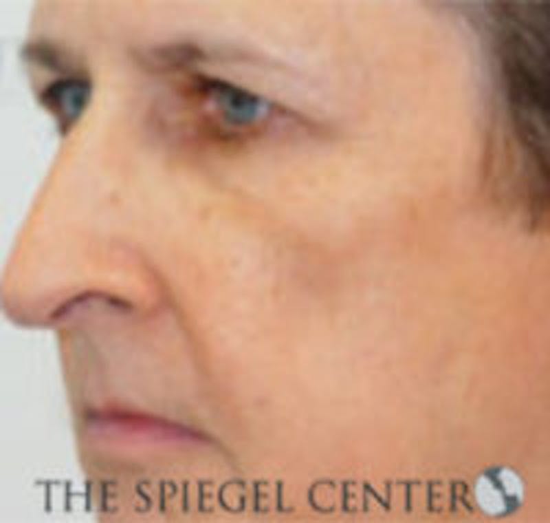 Rhinoplasty Before & After Gallery - Patient 146655 - Image 1