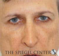 Rhinoplasty Before & After Gallery - Patient 146655 - Image 3