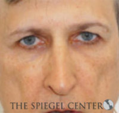 Rhinoplasty Before & After Gallery - Patient 146655 - Image 3