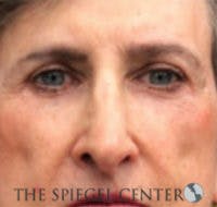 Rhinoplasty Before & After Gallery - Patient 146655 - Image 4