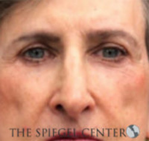 Rhinoplasty Before & After Gallery - Patient 146655 - Image 4