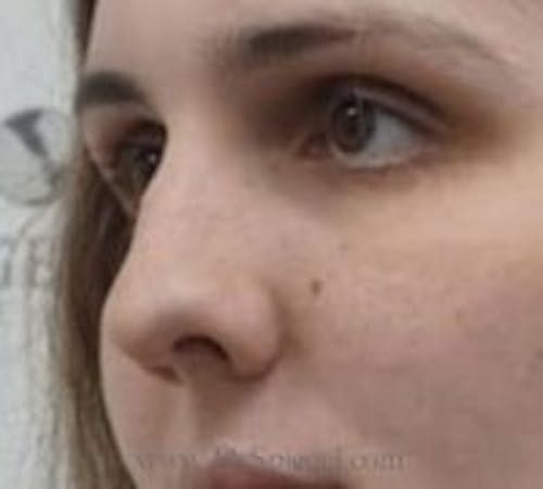 Rhinoplasty Before & After Gallery - Patient 430464 - Image 1