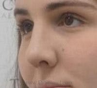 Rhinoplasty Before & After Gallery - Patient 430464 - Image 2