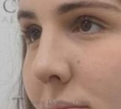 Rhinoplasty Before & After Gallery - Patient 430464 - Image 2