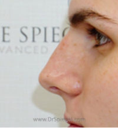 Rhinoplasty Before & After Gallery - Patient 426253 - Image 1