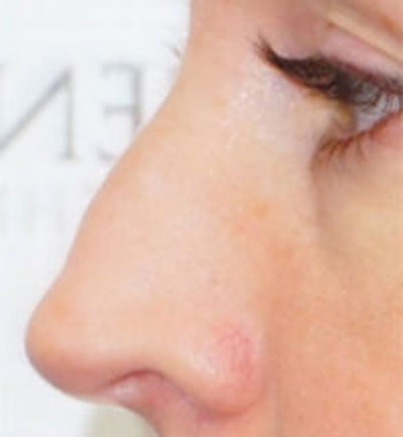 Rhinoplasty Before & After Gallery - Patient 378269 - Image 1