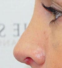 Rhinoplasty Before & After Gallery - Patient 378269 - Image 2