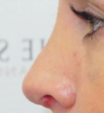 Rhinoplasty Before & After Gallery - Patient 378269 - Image 2