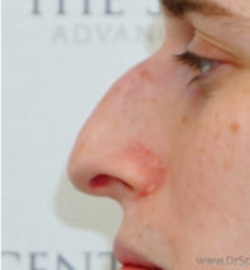 Rhinoplasty Before & After Gallery - Patient 391589 - Image 1
