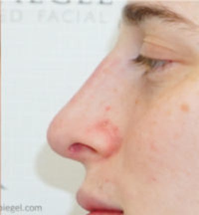 Rhinoplasty Before & After Gallery - Patient 391589 - Image 2