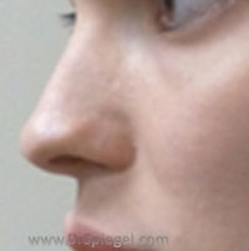 Rhinoplasty Before & After Gallery - Patient 350061 - Image 1
