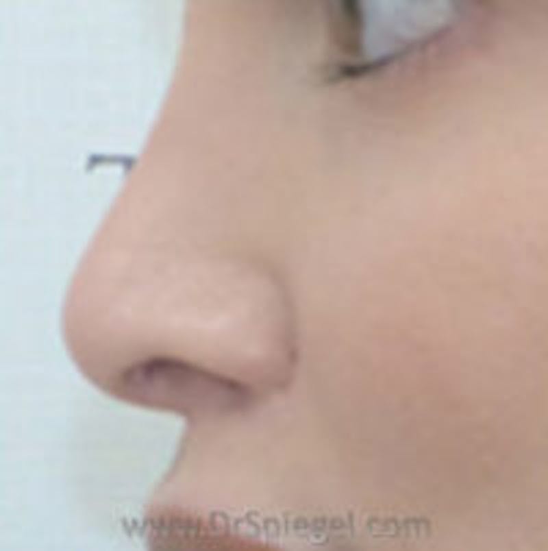 Rhinoplasty Before & After Gallery - Patient 350061 - Image 2