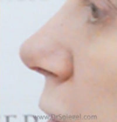 Rhinoplasty Before & After Gallery - Patient 387905 - Image 2