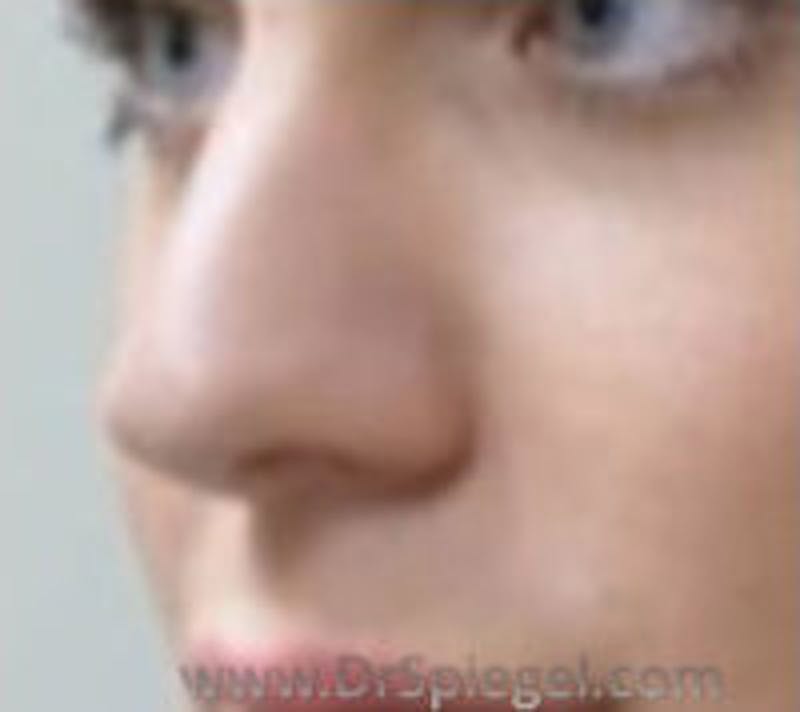 Rhinoplasty Before & After Gallery - Patient 390064 - Image 1