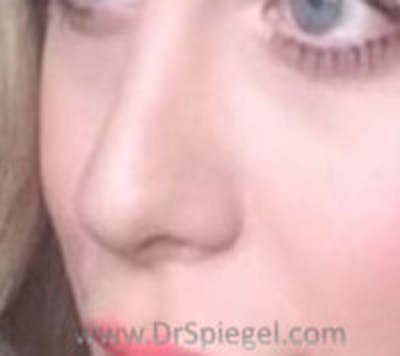 Rhinoplasty Before & After Gallery - Patient 390064 - Image 2