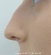 Rhinoplasty Before & After Gallery - Patient 197584 - Image 1