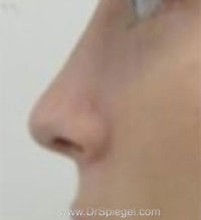 Rhinoplasty Before & After Gallery - Patient 197584 - Image 2