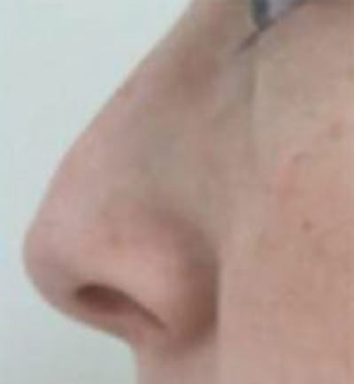 Rhinoplasty Before & After Gallery - Patient 251991 - Image 1