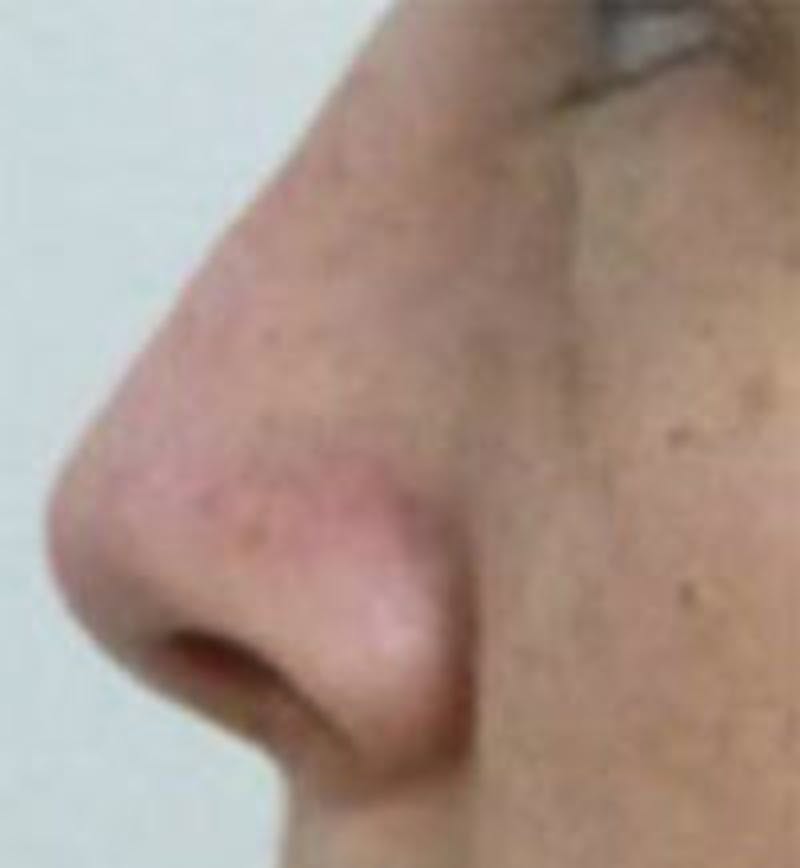 Rhinoplasty Before & After Gallery - Patient 251991 - Image 2