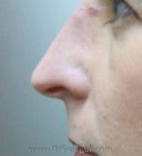 Rhinoplasty Before & After Gallery - Patient 530106 - Image 1