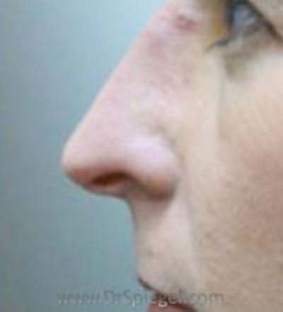 Rhinoplasty Before & After Gallery - Patient 530106 - Image 1