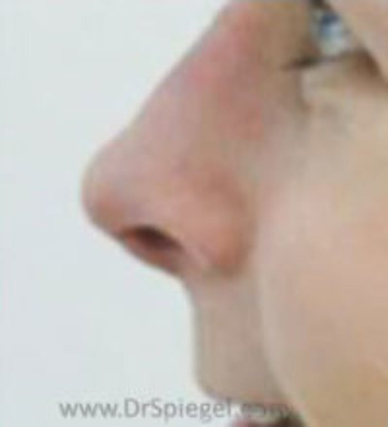 Rhinoplasty Before & After Gallery - Patient 530106 - Image 2