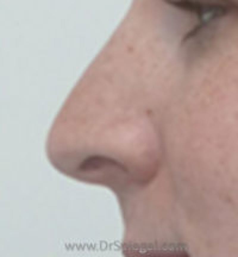 Rhinoplasty Before & After Gallery - Patient 216421 - Image 1