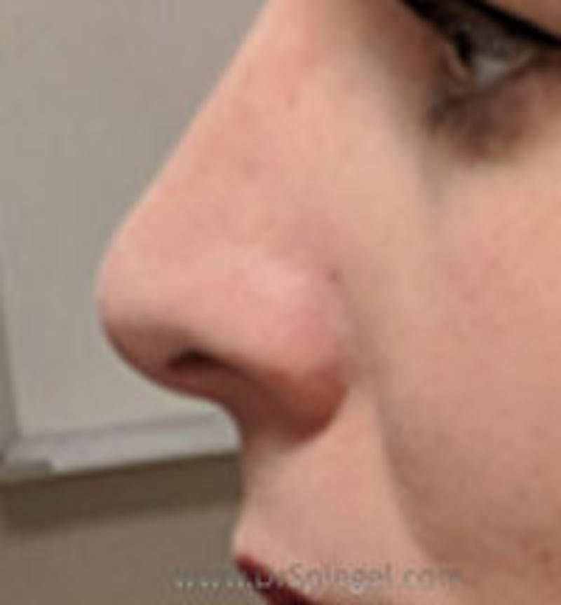 Rhinoplasty Before & After Gallery - Patient 216421 - Image 2