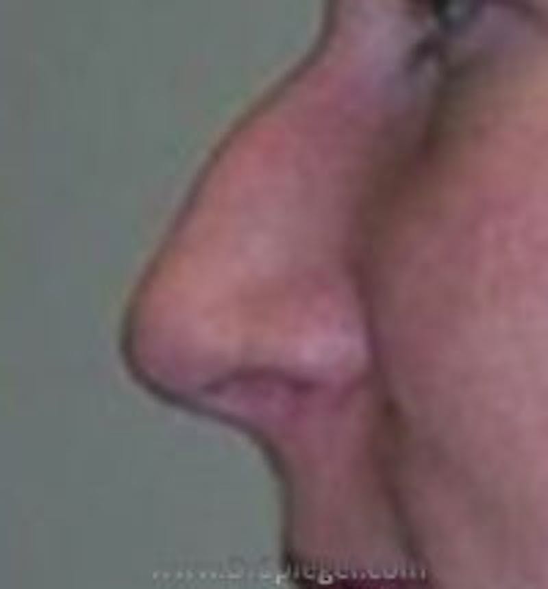 Rhinoplasty Before & After Gallery - Patient 226637 - Image 1