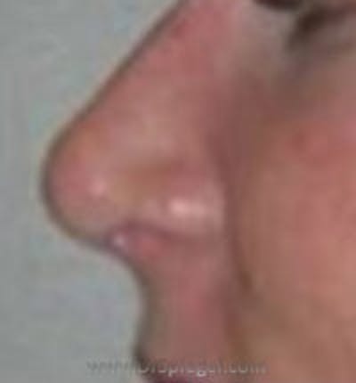 Rhinoplasty Before & After Gallery - Patient 226637 - Image 2