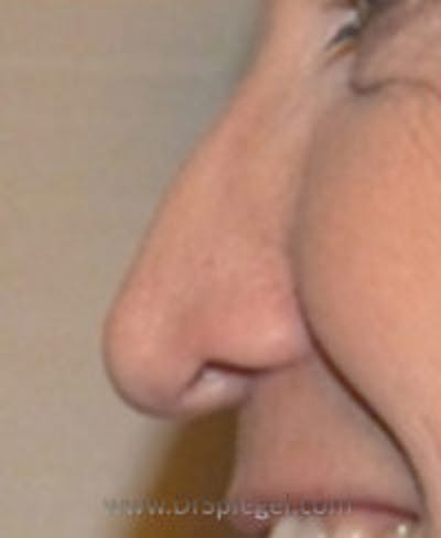 Rhinoplasty Before & After Gallery - Patient 242688 - Image 1