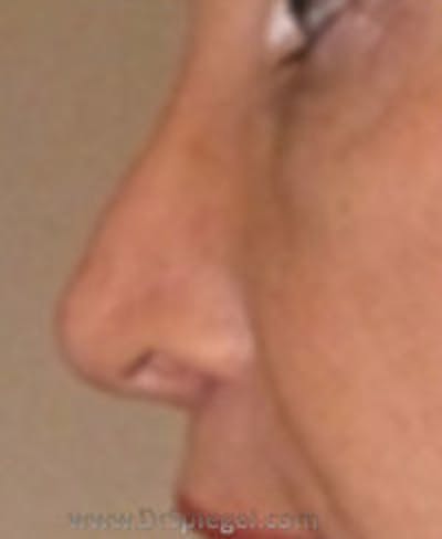 Rhinoplasty Before & After Gallery - Patient 242688 - Image 2
