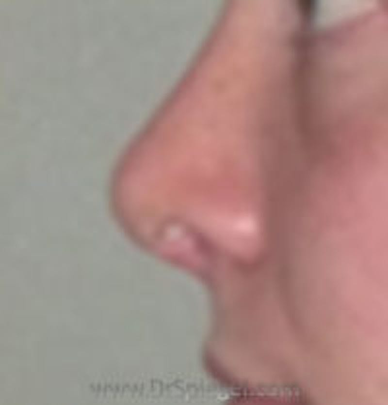 Rhinoplasty Before & After Gallery - Patient 159506 - Image 2