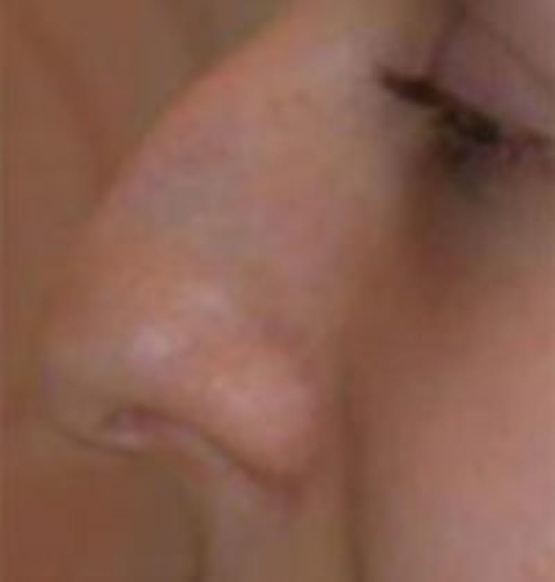 Rhinoplasty Before & After Gallery - Patient 996041 - Image 1