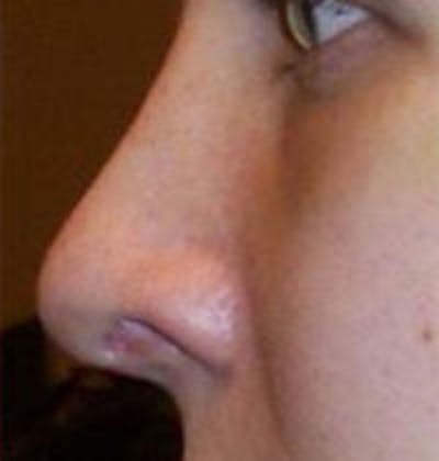 Rhinoplasty Before & After Gallery - Patient 996041 - Image 2