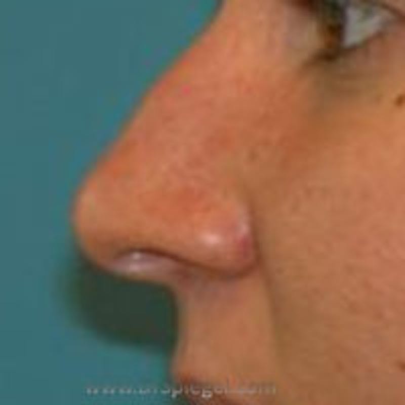 Rhinoplasty Before & After Gallery - Patient 180867 - Image 1