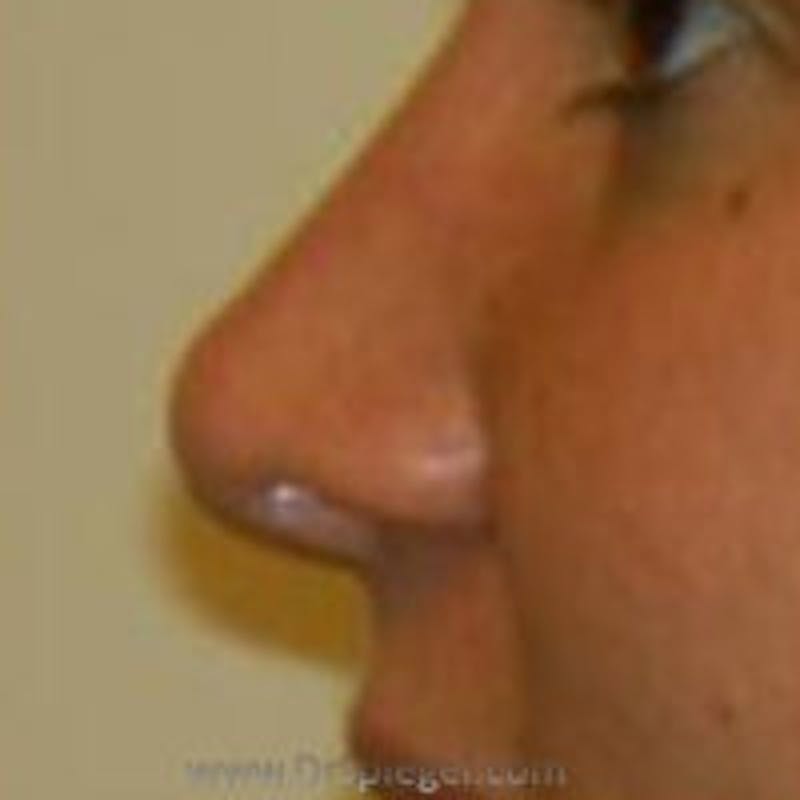 Rhinoplasty Before & After Gallery - Patient 180867 - Image 2