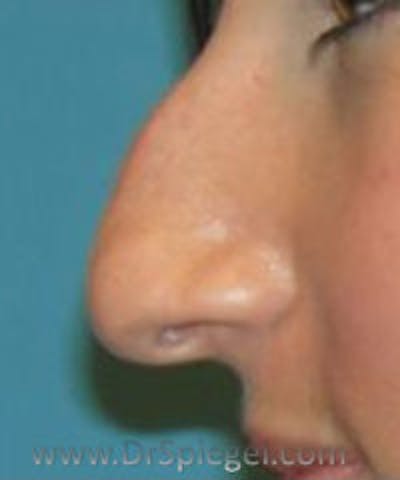 Rhinoplasty Before & After Gallery - Patient 260090 - Image 1