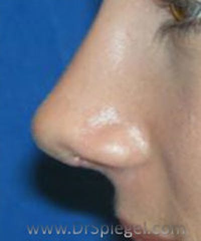 Rhinoplasty Before & After Gallery - Patient 260090 - Image 2