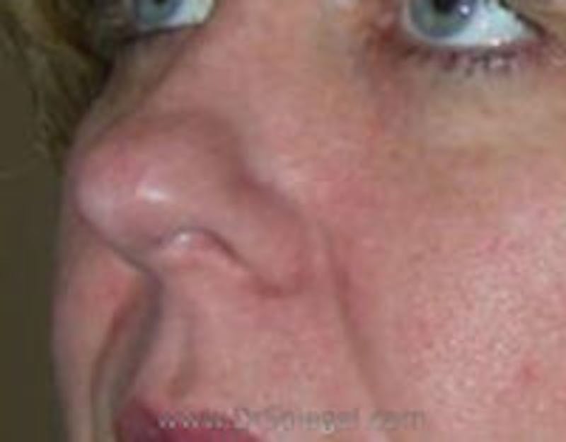 Rhinoplasty Before & After Gallery - Patient 296010 - Image 1