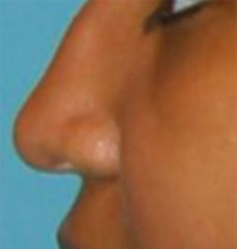 Rhinoplasty Before & After Gallery - Patient 122291 - Image 1