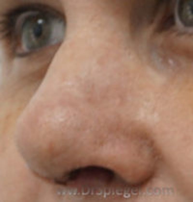 Rhinoplasty Before & After Gallery - Patient 281218 - Image 1