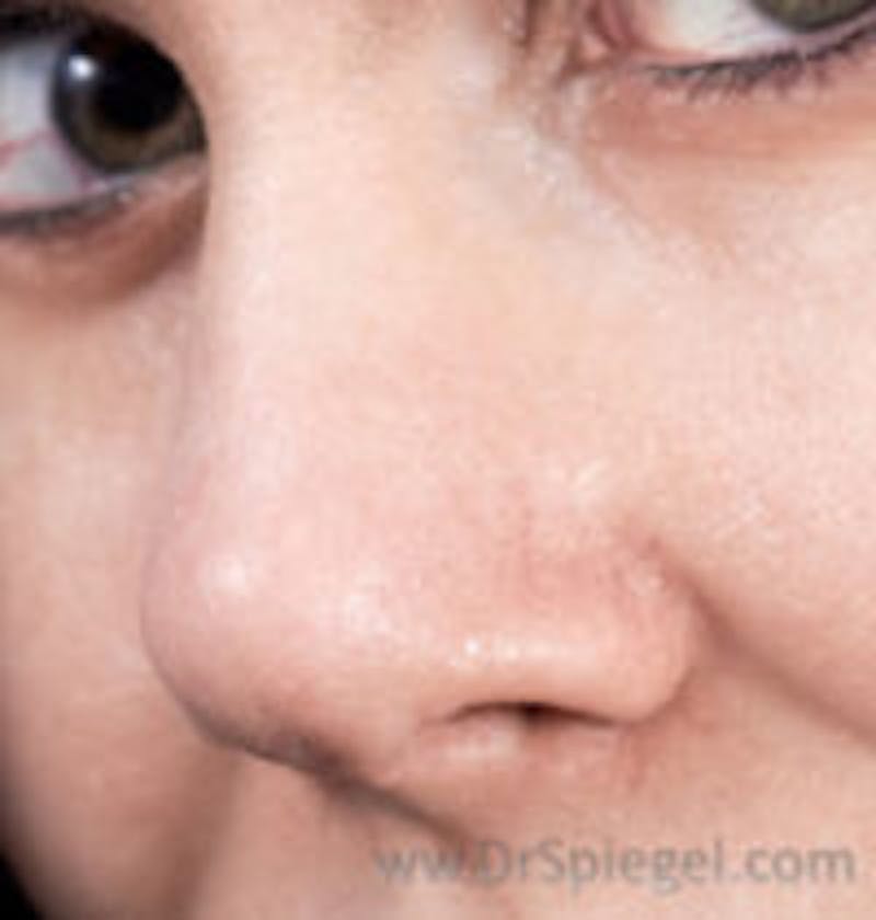 Rhinoplasty Before & After Gallery - Patient 281218 - Image 2